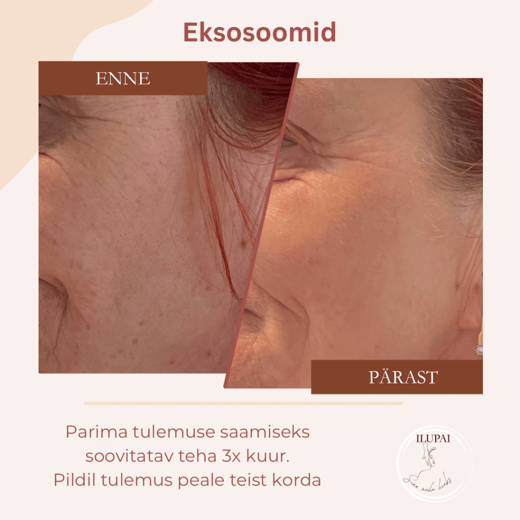 Microneedlingu tulemoused enne ja pärast protseduuri Ilupai Skincare Pärnus
