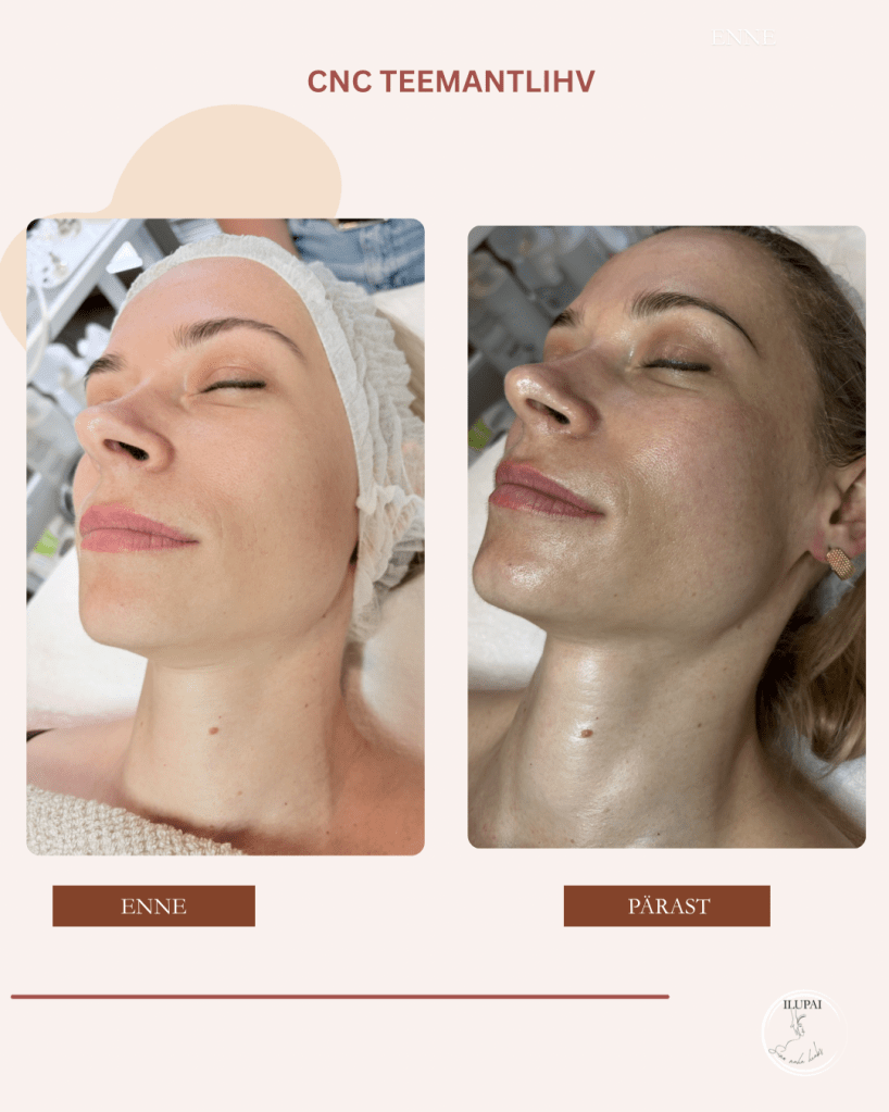 CNC teemantlihvi tulemus ilupai skincare