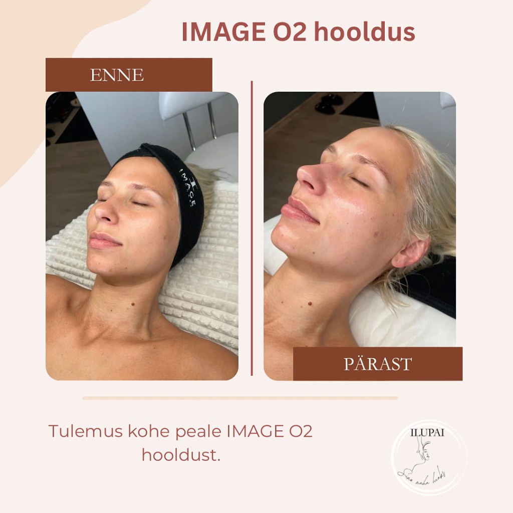 tulemus peale IMAGE O2 hapnikuhooldust