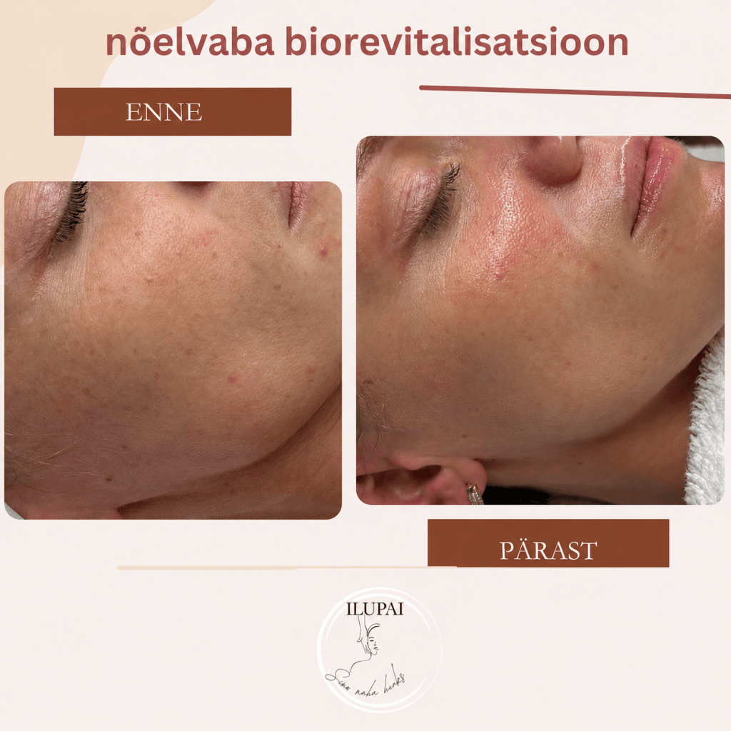 nõelvaba biorevitalisatsiooni tulemus peale esimest protseduuri