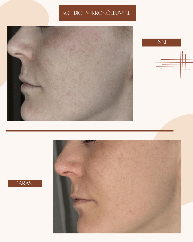 SQT biomicroneedlingu enne-pärast tulemus